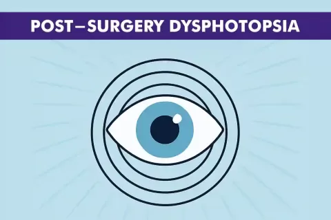Cataract Surgery – How To Choose The Best Eye Care Center?