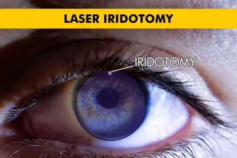 Cataract Surgery – How To Choose The Best Eye Care Center?