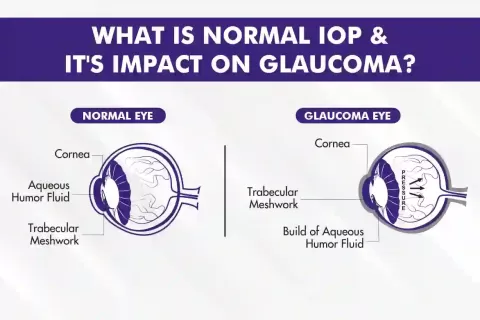 Cataract Surgery – How To Choose The Best Eye Care Center?