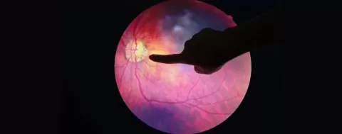 Cataract Surgery – How To Choose The Best Eye Care Center?