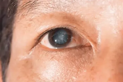Cataract Surgery – How To Choose The Best Eye Care Center?