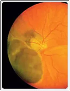 Cataract Surgery – How To Choose The Best Eye Care Center?