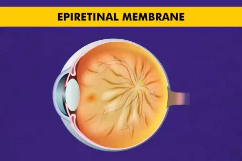 Cataract Surgery – How To Choose The Best Eye Care Center?