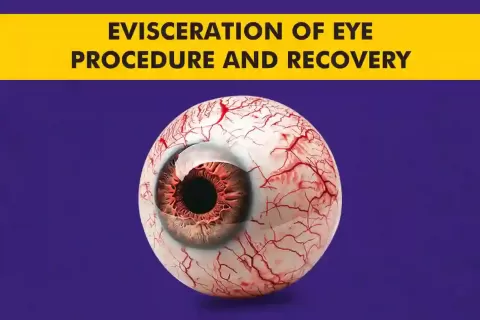Cataract Surgery – How To Choose The Best Eye Care Center?
