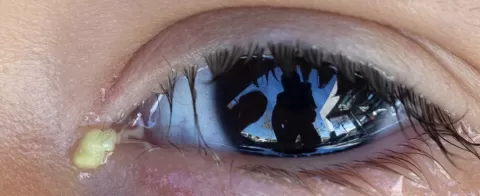 Cataract Surgery – How To Choose The Best Eye Care Center?