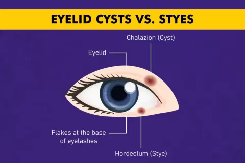 Cataract Surgery – How To Choose The Best Eye Care Center?