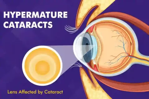 Cataract Surgery – How To Choose The Best Eye Care Center?