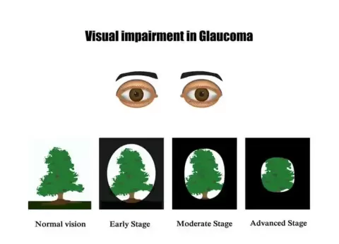 Cataract Surgery – How To Choose The Best Eye Care Center?