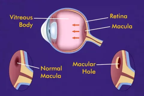 Cataract Surgery – How To Choose The Best Eye Care Center?