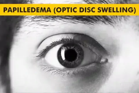 Cataract Surgery – How To Choose The Best Eye Care Center?
