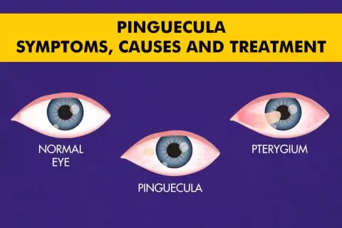 Cataract Surgery – How To Choose The Best Eye Care Center?