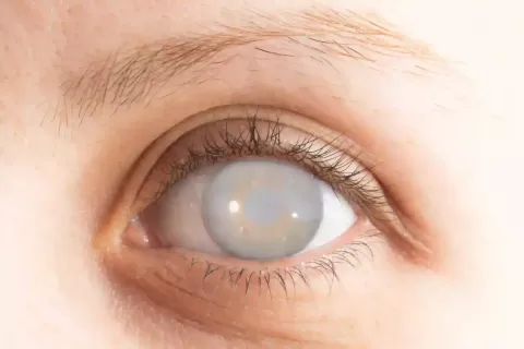 Cataract Surgery – How To Choose The Best Eye Care Center?