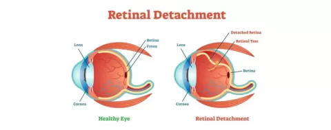 Cataract Surgery – How To Choose The Best Eye Care Center?