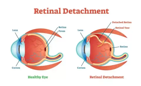 Cataract Surgery – How To Choose The Best Eye Care Center?