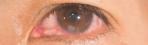 Cataract Surgery – How To Choose The Best Eye Care Center?