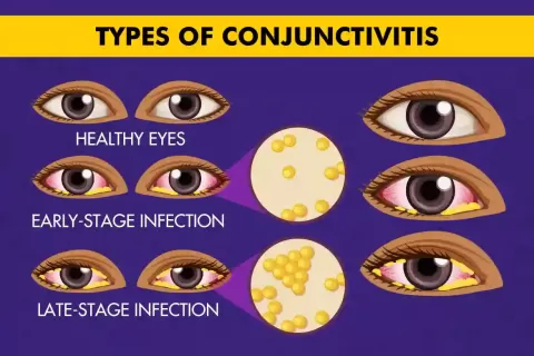 Cataract Surgery – How To Choose The Best Eye Care Center?