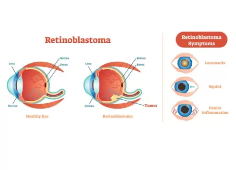 Cataract Surgery – How To Choose The Best Eye Care Center?