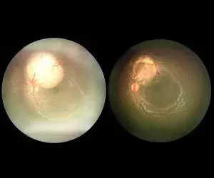 Cataract Surgery – How To Choose The Best Eye Care Center?