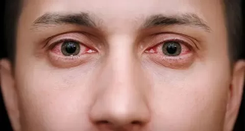 Cataract Surgery – How To Choose The Best Eye Care Center?