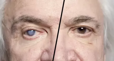 Cataract Surgery – How To Choose The Best Eye Care Center?