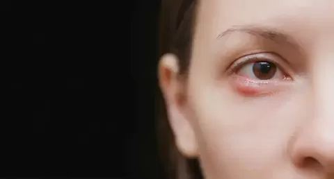 Cataract Surgery – How To Choose The Best Eye Care Center?