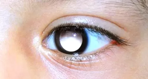 Cataract Surgery – How To Choose The Best Eye Care Center?