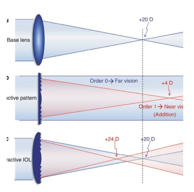 Multifocal lens diagram