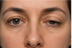 CornealTransplant