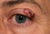Eyelid-and-Orbital-Tumours