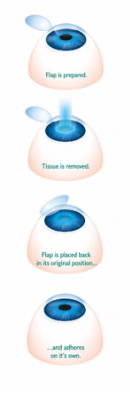 Multifocal lens diagram