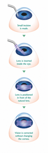 Toric lens diagram