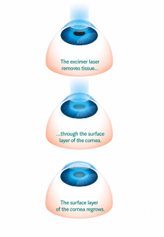 Monofocal lens diagram