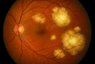 Secondary-and-Metastatic-Eye-Cancers