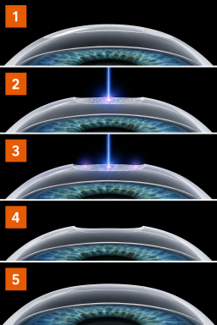 Cataract causes