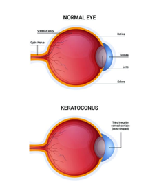 Doctor performing cataract examination