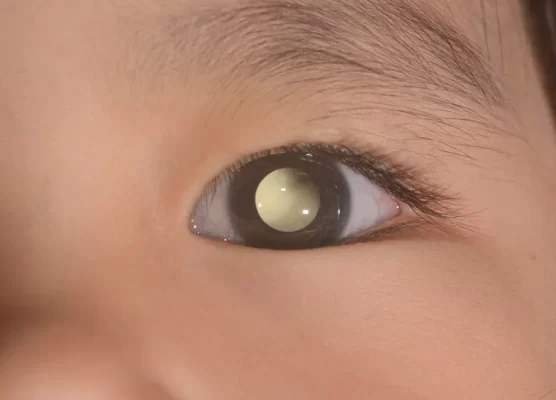 India has highest number of Retinoblastoma effected children