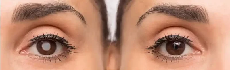 Right Time for Cataract Surgery