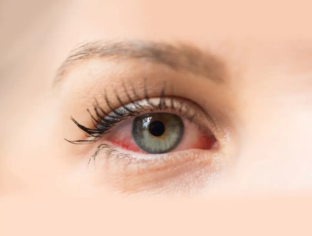 Infographic detailing conjunctivitis causes, symptoms, and treatments