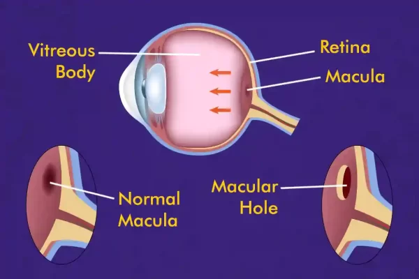 Macular Hole