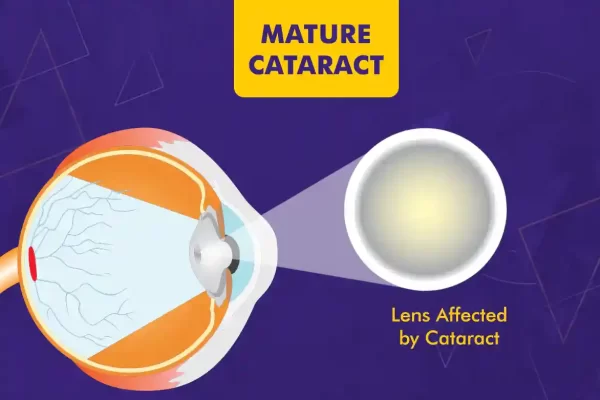 Mature Cataract