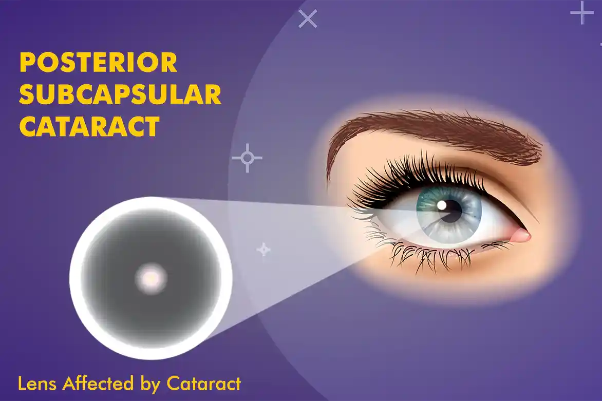 Posterior Subcapsular Cataract (PSC)