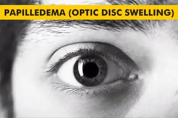 Papilledema-Optic Disc Swelling