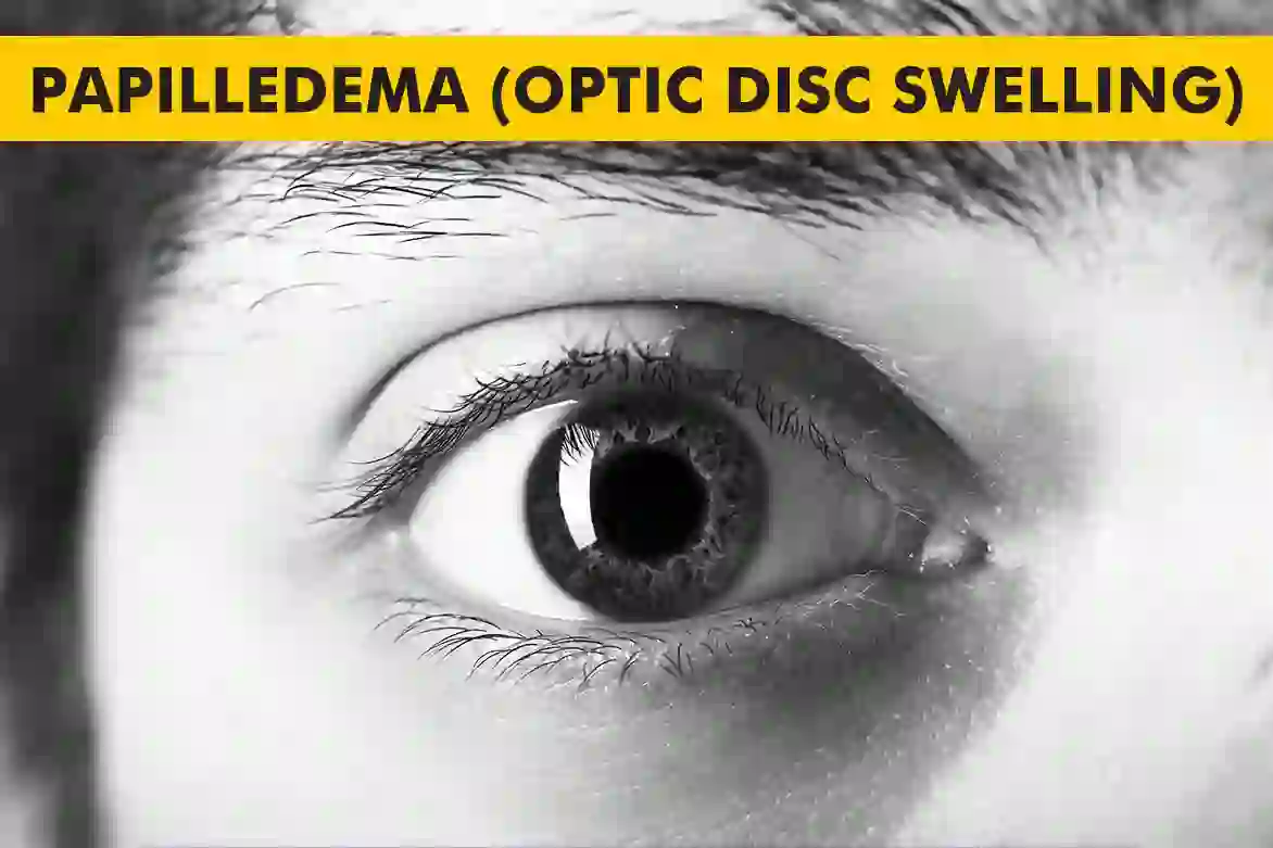 Papilledema-Optic Disc Swelling