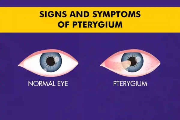 Signs and symptoms of pterygium