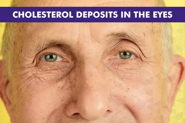 Cholesterol Deposits in Eyes