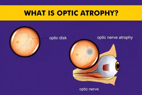 Optic Atrophy - Understanding the Condition