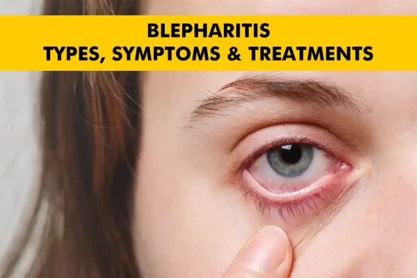 Blepharitis