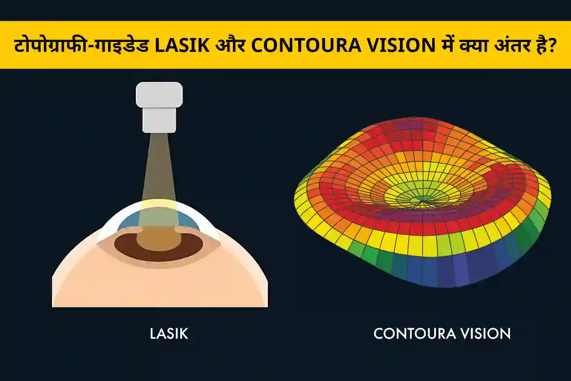 टोपोग्राफी-गाइडेड LASIK बनाम Contoura Vision