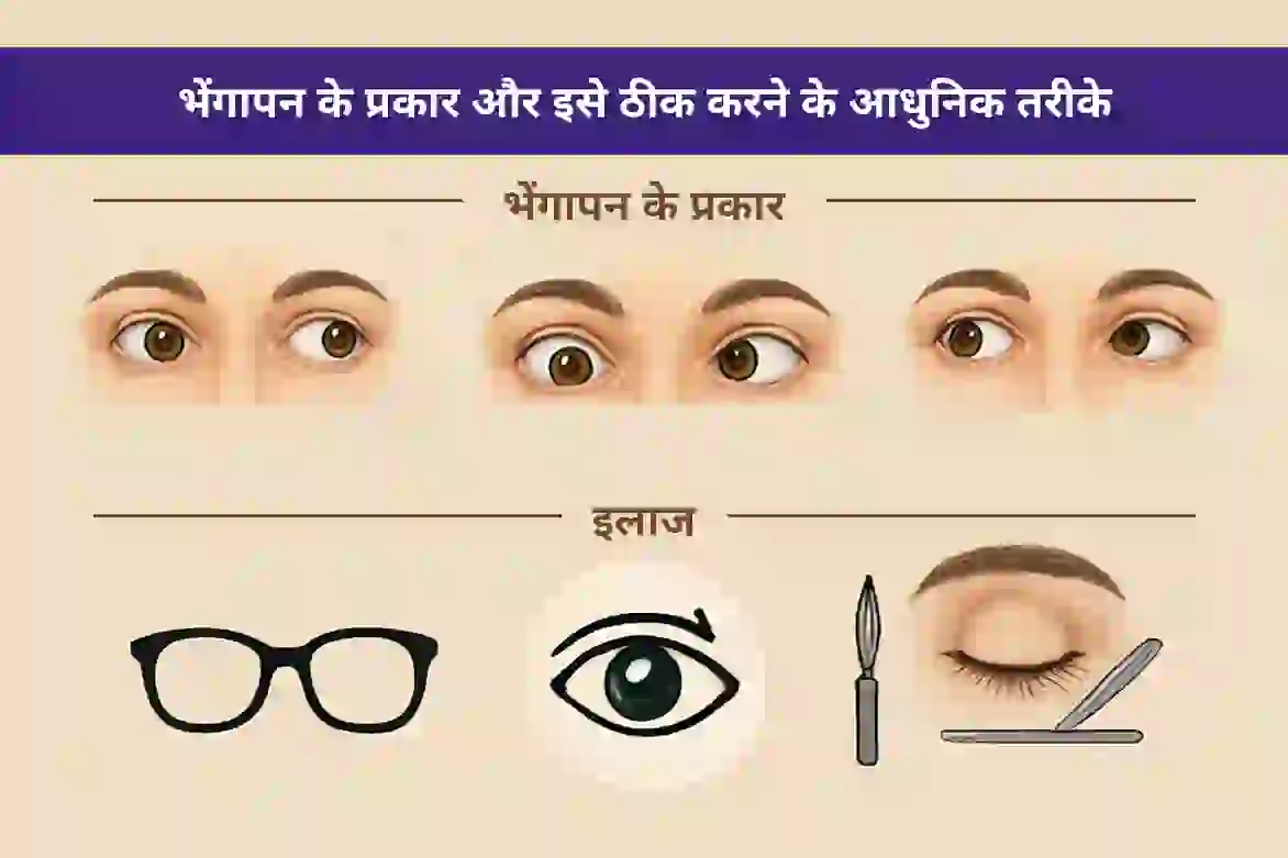 भेंगापन (स्क्विंट) के प्रकार और इलाज के आधुनिक विकल्प