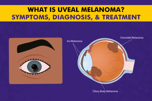 Uveal Melanoma